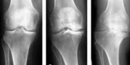 Gonarthrosis 3 fok
