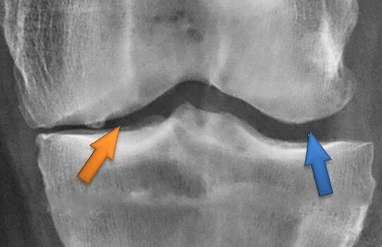 Kines -natherapy arthrosis számára